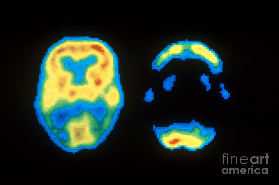 Pet Scan Photograph - Pet Scans Of Normal And Alzheimers Brain by Science Source