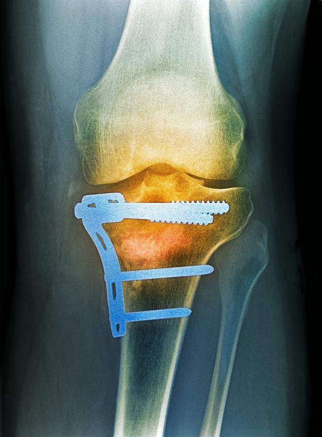 Pinned Broken Knee, X-ray by.