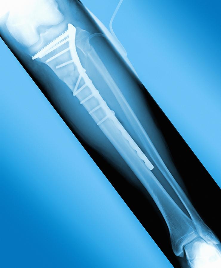 Skeleton Photograph - Pinned Broken Leg, X-ray by Miriam Maslo