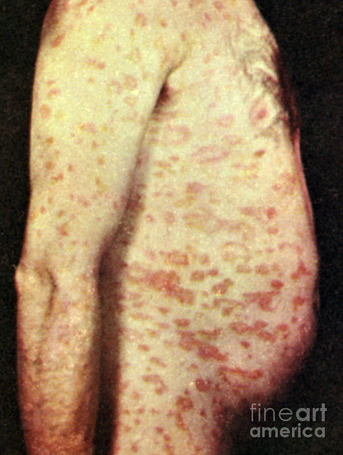 Pityriasis Rosea Photograph by Science Source