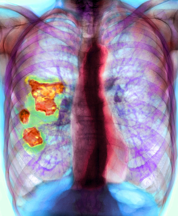 Pleural Plaque X Ray Photograph By Du Cane Medical Imaging Ltd Pixels 3654