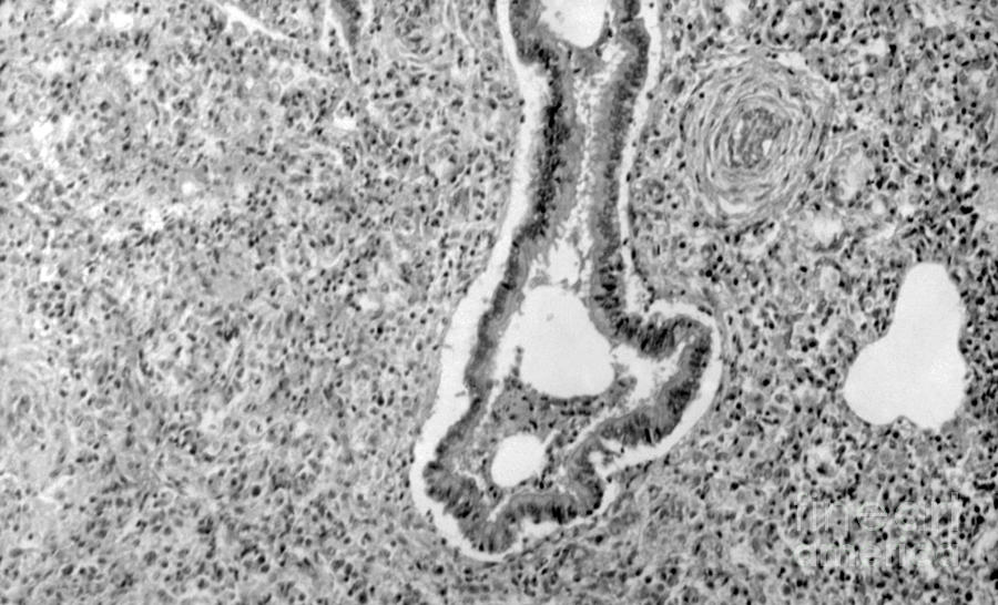 Pneumonia Alba In Congenital Syphilis Photograph by Science Source