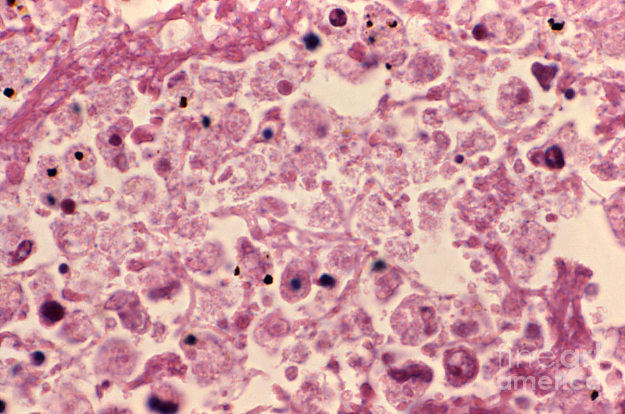 Science Photograph - Pneumonia  Legionnaires Disease, Lm by Science Source