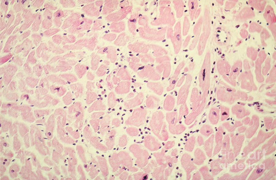 Pathology Photograph - Pneumonia by Science Source