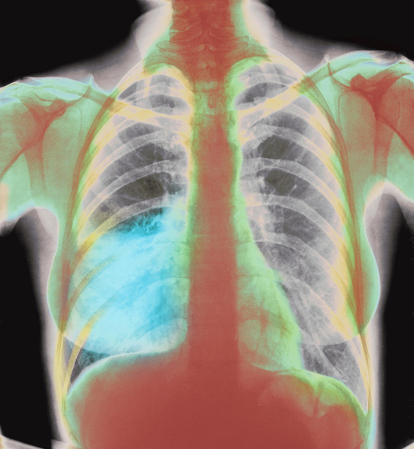 Pneumonia X-ray Photograph by - Fine Art America