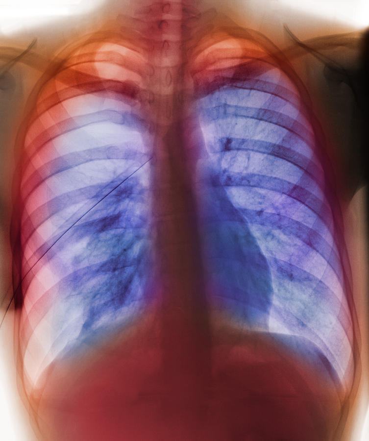 Pneumothorax Photograph by - Fine Art America