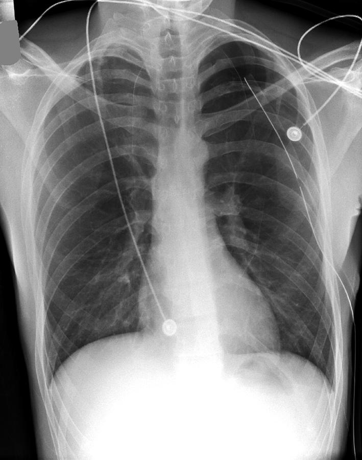 'pneumothorax Treatment, X-ray' Photograph by Du Cane Medical Imaging ...