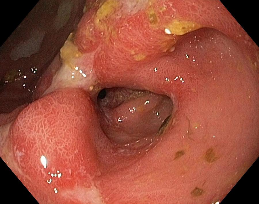 Pyloric Photograph - Prepyloric Ulcer In The Stomach by Gastrolab