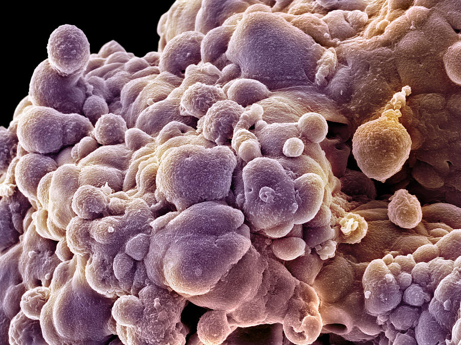 Disease Photograph - Prostate Cancer Cells, Sem by David Mccarthy