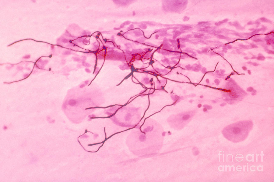 Science Photograph - Pulmonary Candidiasis, Lm by Science Source