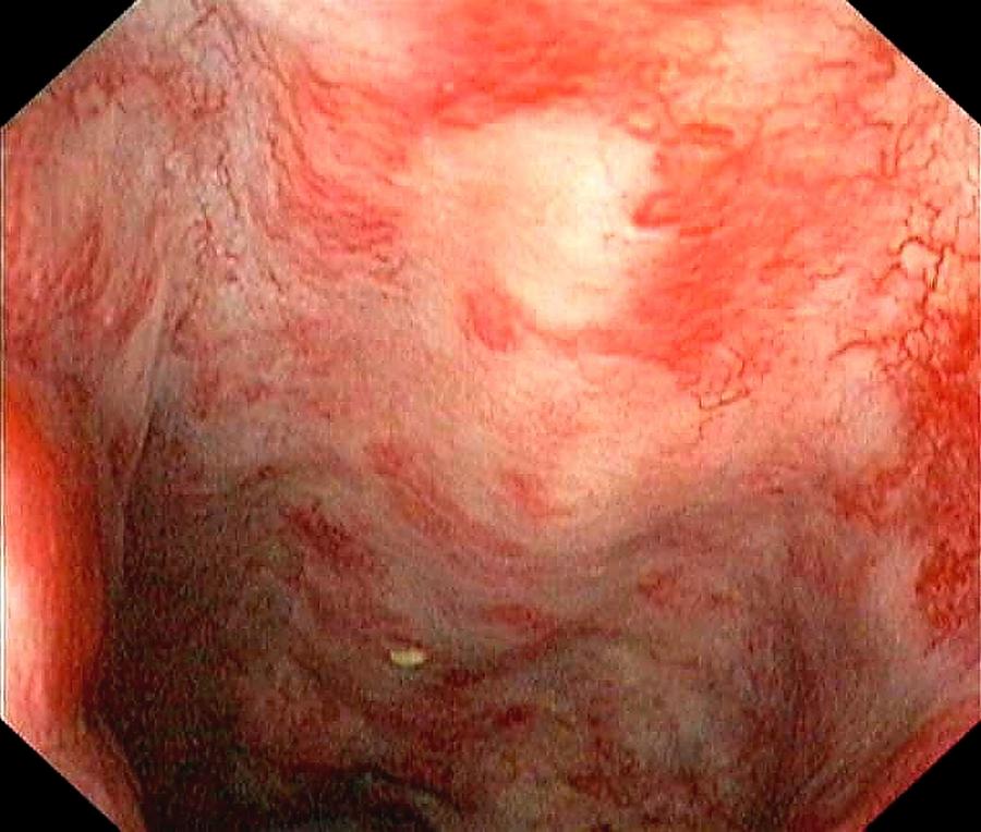 Endoscopy Photograph - Rectal Damage From Radiation Therapy by Gastrolab