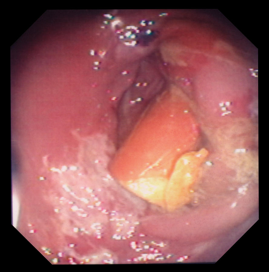 Rectum Photograph - Rectal Inflammation by David M. Martin, Md
