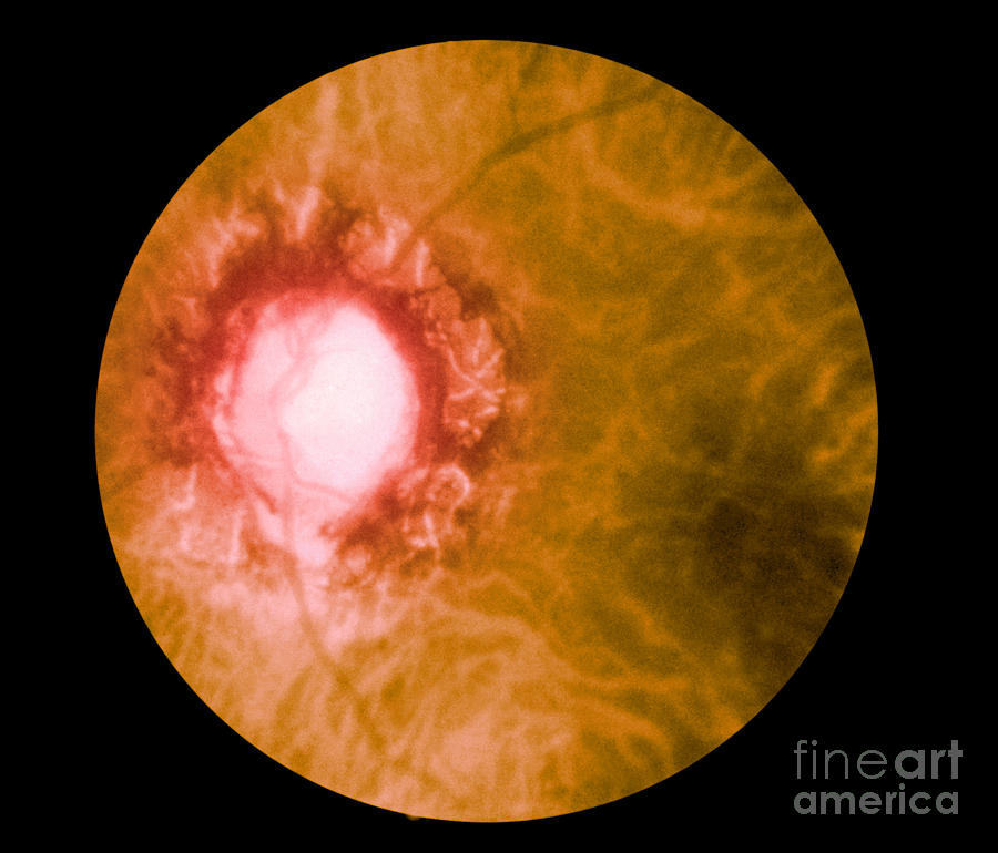 Retina Infected By Syphilis Photograph by Science Source
