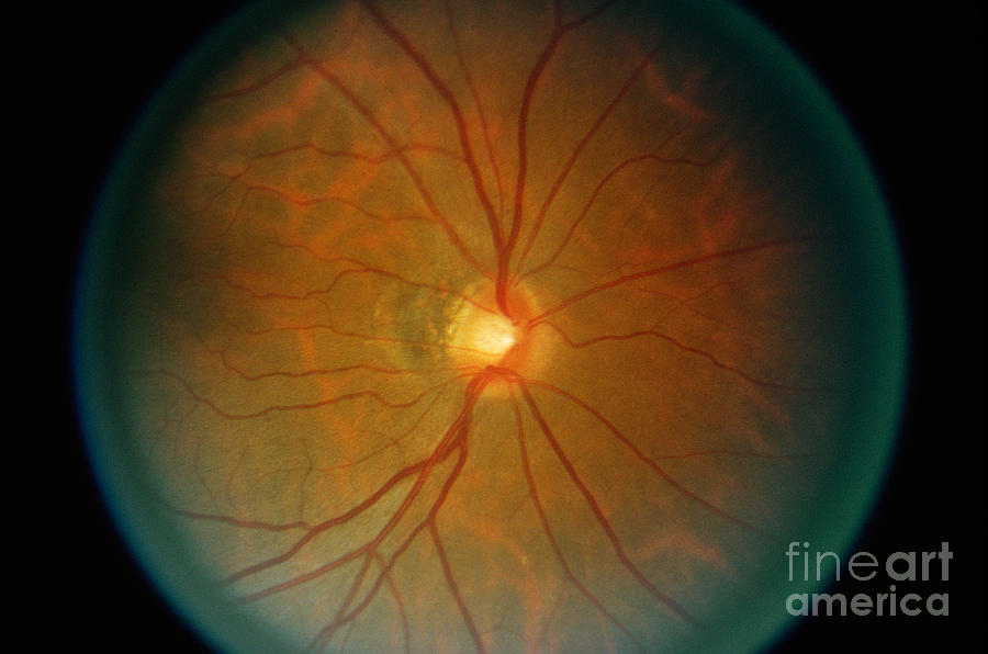 Retina, Lupus Patient Photograph by Science Source