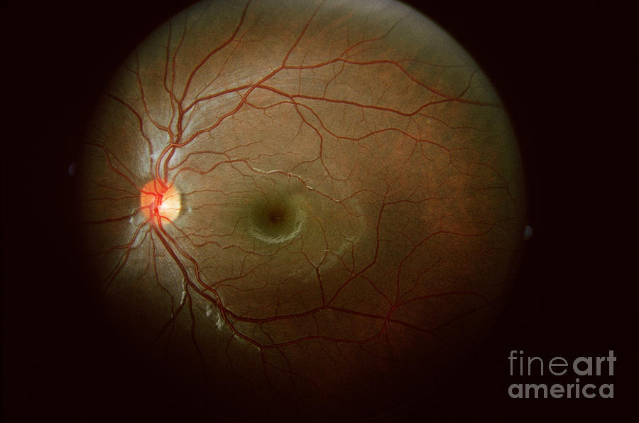 Retinal Coloboma Photograph by Science Source