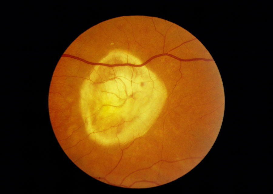 Retinal Degeneration Photograph by Paul Parker - Pixels