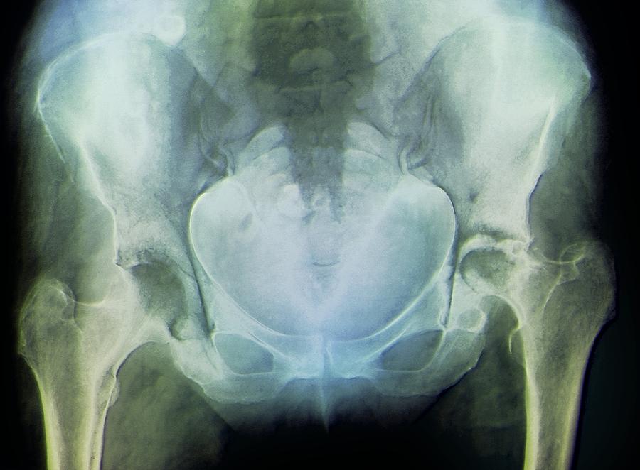 Rheumatoid Arthritis Of The Hip X Ray Photograph By Zephyr