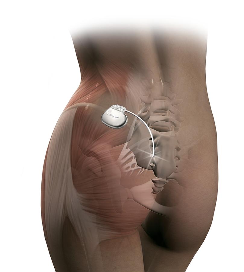 General Stim's implanted sacral nerve stimulation approved in