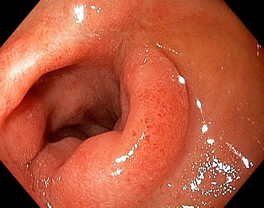 Endoscopy Photograph - Scar From A Duodenal Ulcer by Gastrolab