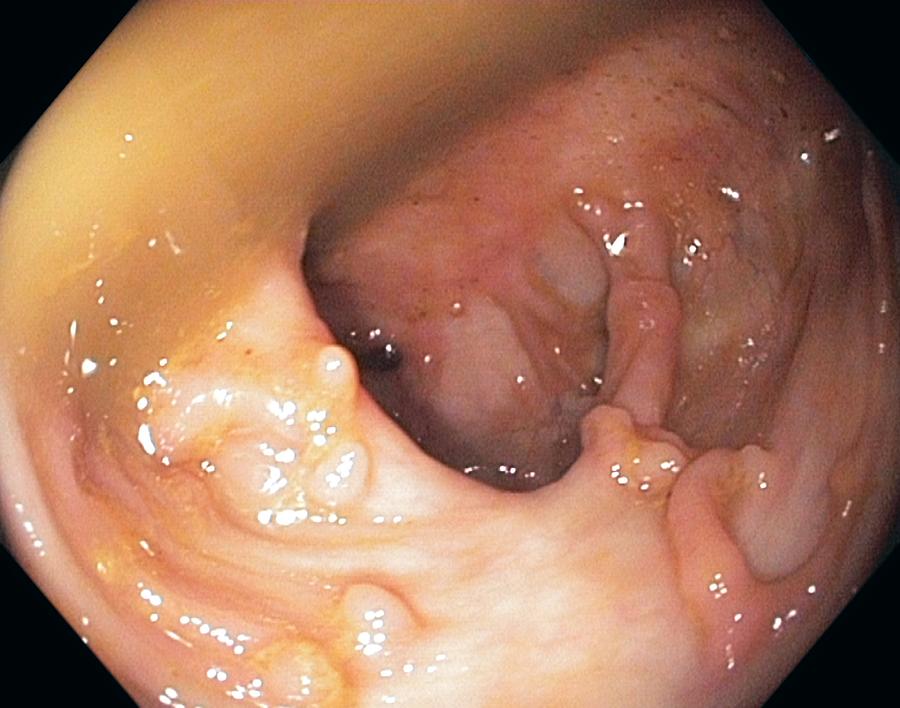 Crohn's Disease Photograph - Scarred Colon by Gastrolab