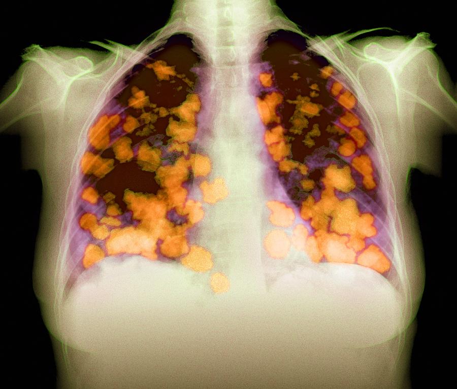 Secondary Lung Cancers, X-ray Photograph by Du Cane Medical Imaging Ltd ...