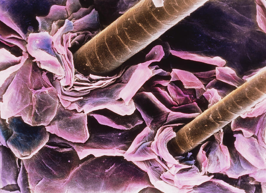 Псориаз под микроскопом фото