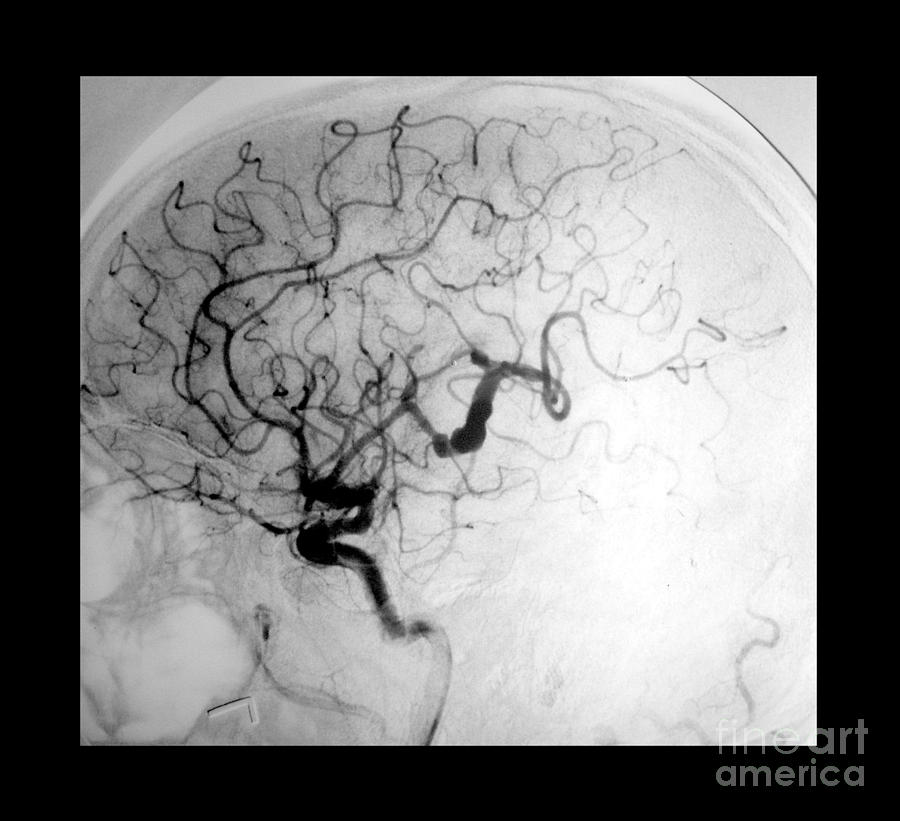 Serpentine Aneurysm Photograph by Medical Body Scans