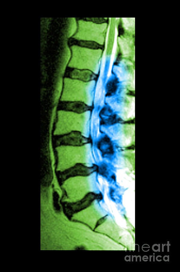 Severe Facet Joint Degeneration Photograph by Medical Body Scans