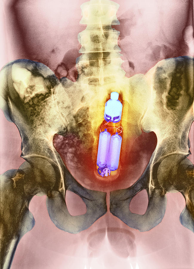 Sex Toy In Mans Rectum X Ray Photograph By Du Cane Medical Imaging Ltd