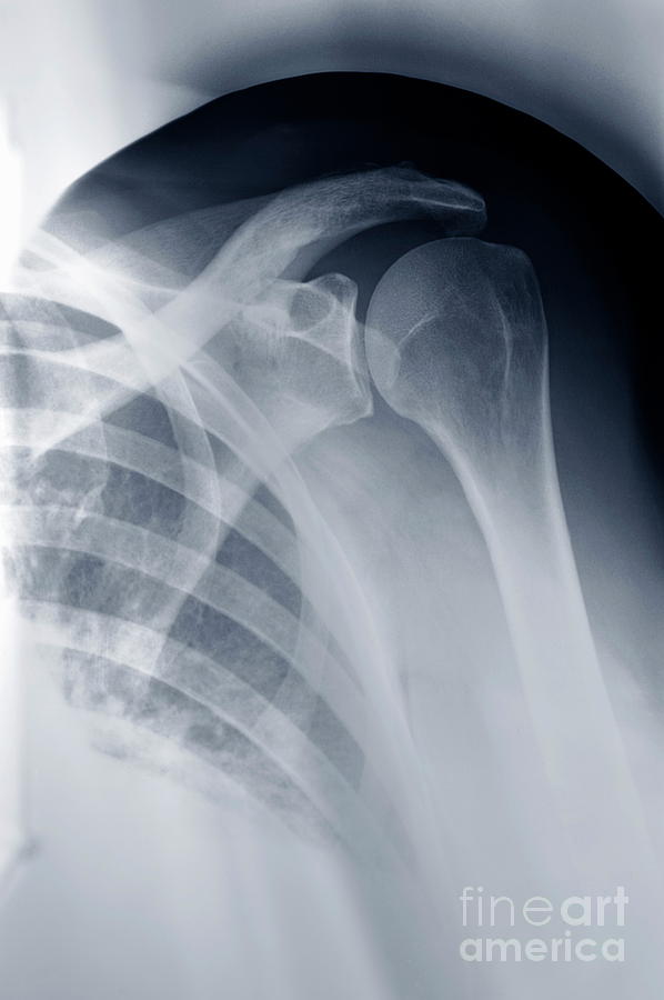 Black And White Photograph - Shoulder X-ray by Sami Sarkis