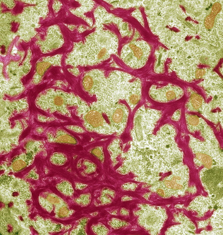Squamous Cell Carcinoma Photograph - Skin Cancer, Tem by Steve Gschmeissner