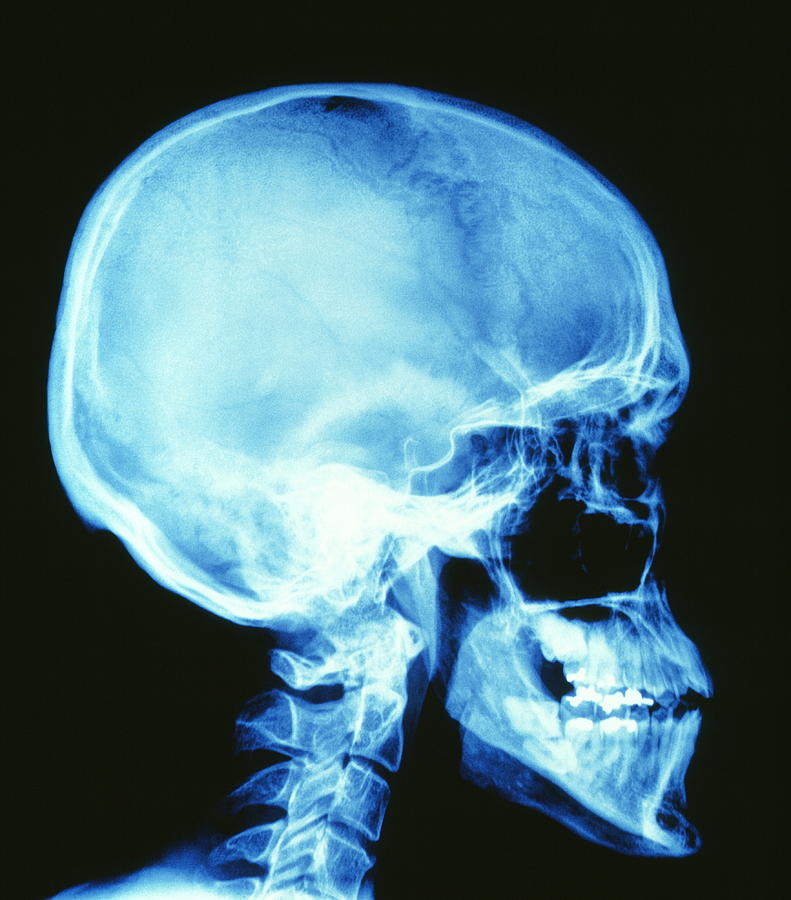 Skull X Ray Photograph By Pasieka Pixels