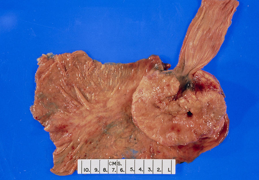 Excised Photograph - Specimen Of Stomach Tissue Diseased With Carcinoma by Dr. E. Walker