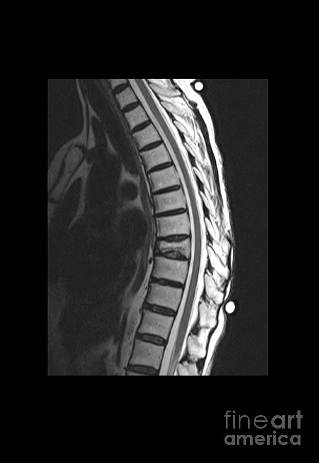 Spinal Compression Fracture Photograph by Medical Body Scans