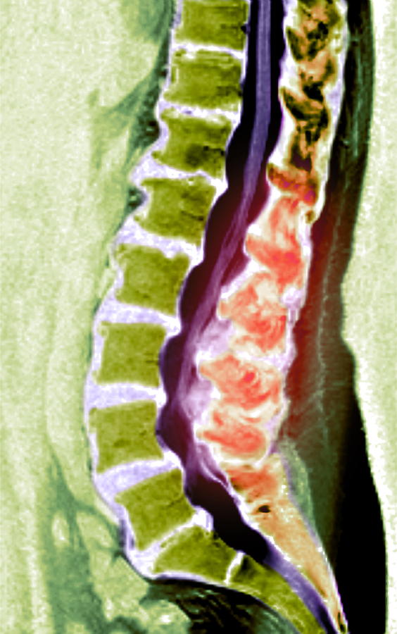 Disorder Photograph - Spine Degeneration, Mri Scan by Du Cane Medical Imaging Ltd