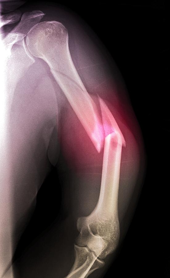 'splintered Arm Fracture, Xray' Photograph by Du Cane Medical Imaging Ltd