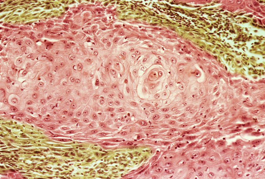 Squamous Cell Carcinoma Photograph - Squamous Cell Carcinoma, Light Micrograph by Steve Gschmeissner