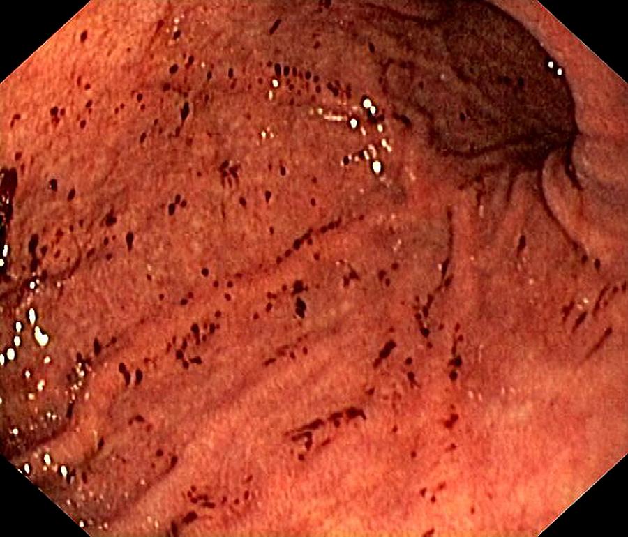 Endoscopy Photograph - Stomach Bleeding From Nsaid Drug by Gastrolab