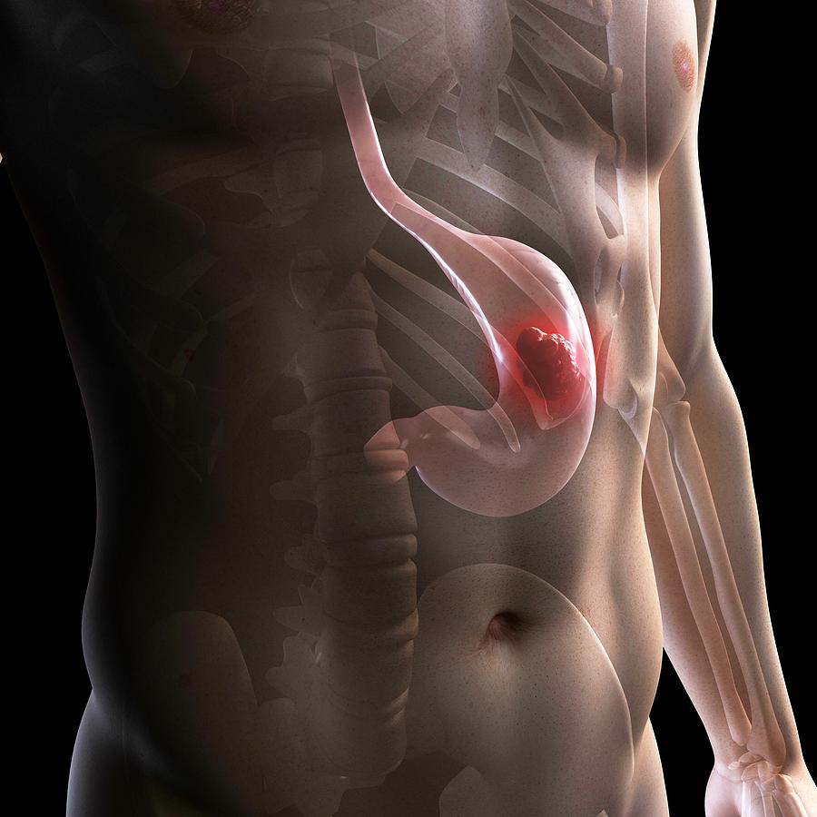 Illustration Photograph - Stomach Cancer, Artwork by Sciepro