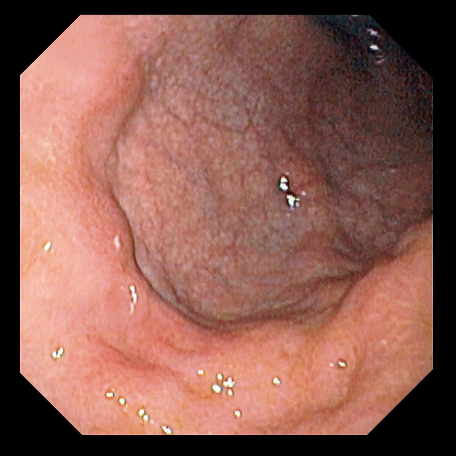 Gastric Photograph - Stomach Cancer by David M. Martin, Md