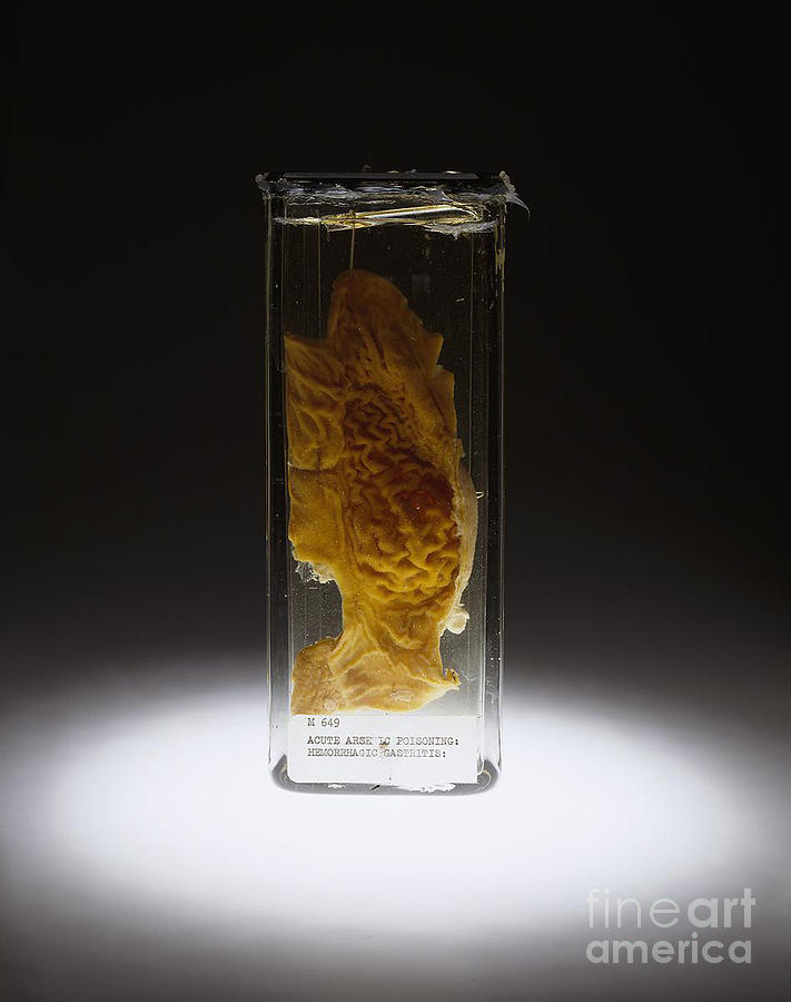 Science Photograph - Stomach, Hemorrhagic Gastritis, Arsenic by Science Source