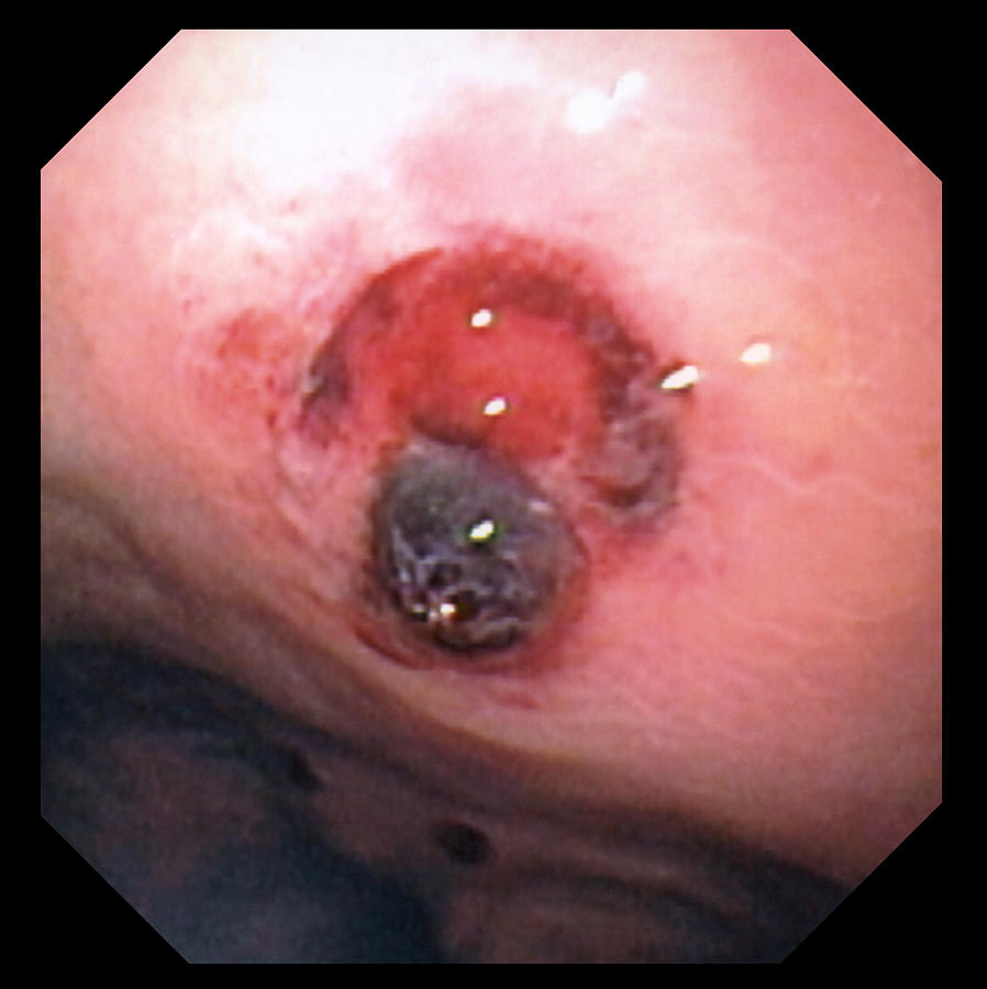 Gastric Ulcer Photograph - Stomach Ulcer by David M. Martin, Md