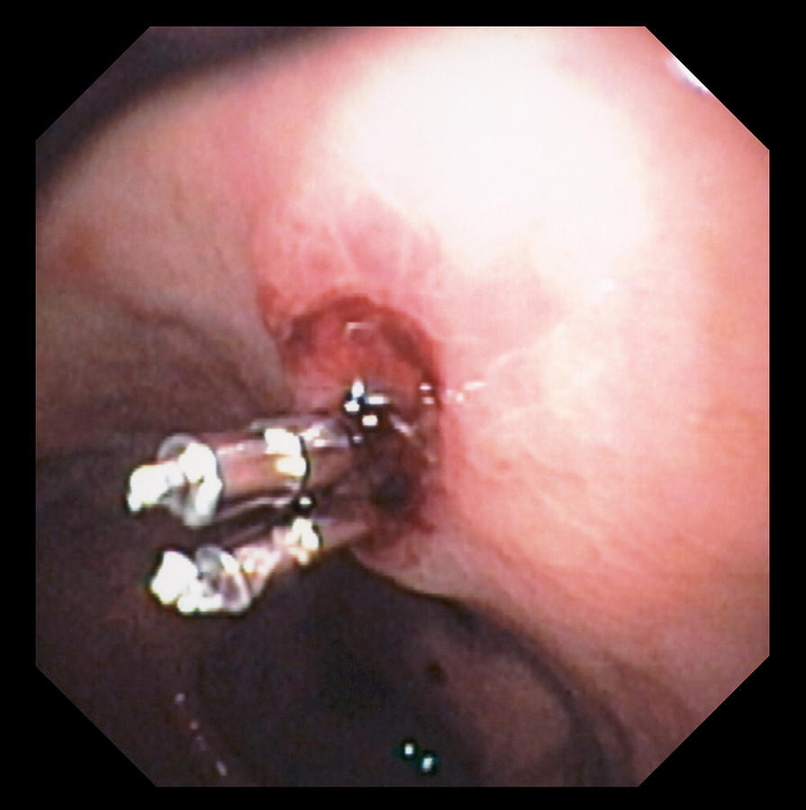 Gastric Ulcer Photograph - Stomach Ulcer Treatment by David M. Martin, Md