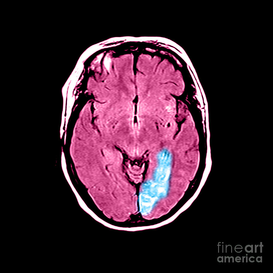 Stroke Photograph by Medical Body Scans