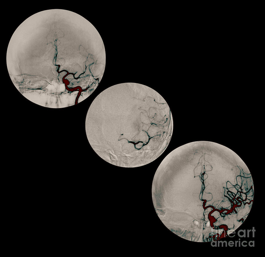 Stroke Treatment Photograph by Medical Body Scans