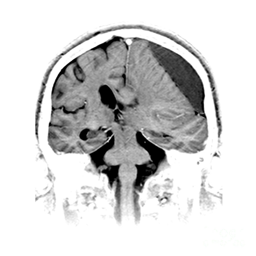 Skull Photograph - Subdural Hematoma by Medical Body Scans