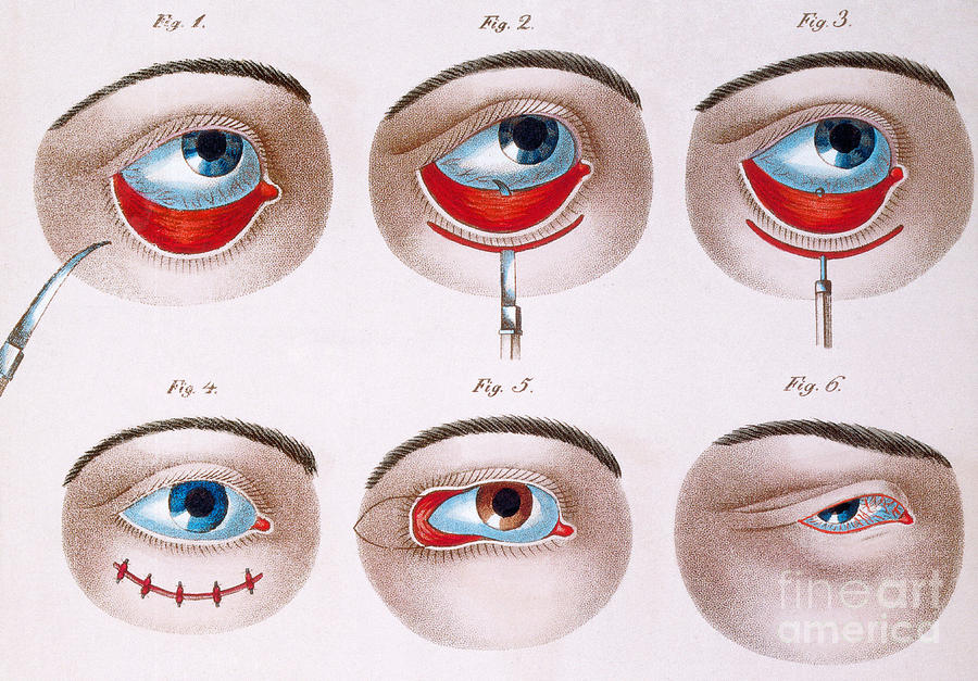 Surgery To Correct Lazy Lower Eyelid Photograph by Science Source