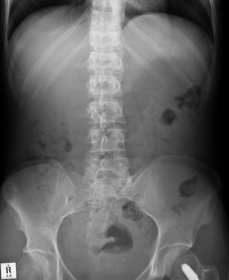 Human Photograph - Swallowed Needles, X-ray by Du Cane Medical Imaging Ltd
