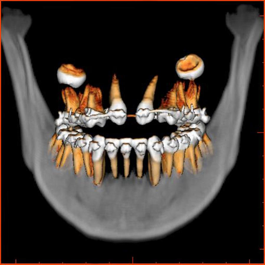 Teeth 3d Ct Scan Photograph By Stanford Radiology 3d Laboratory Fine