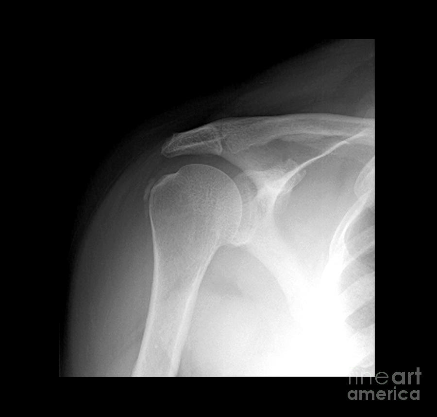 Tendinitis Photograph by Medical Body Scans